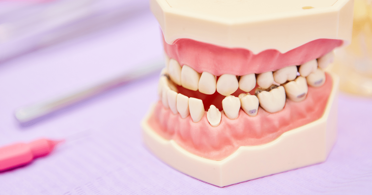 Maloclusión: Qué es y cómo tratarla