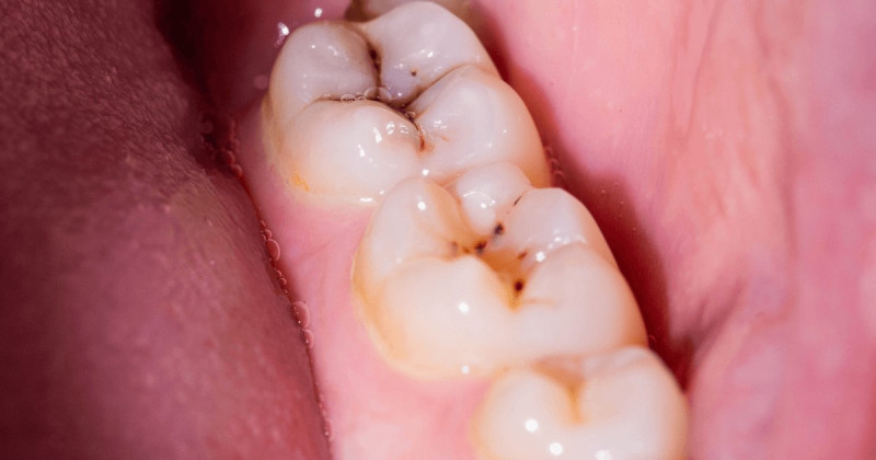 caries-dentales-sintomas-y-tratamiento