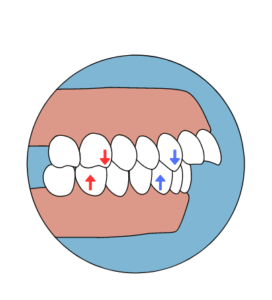 Maloclusión: Qué es y cómo tratarla - Clínica Dental Dentinos