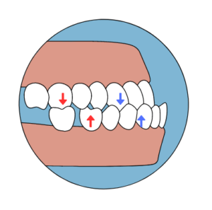 Maloclusión: Qué es y cómo tratarla - Clínica Dental Dentinos