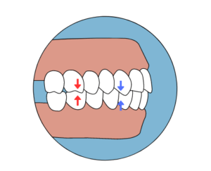 maloclusion. clase I, clase II, clase III