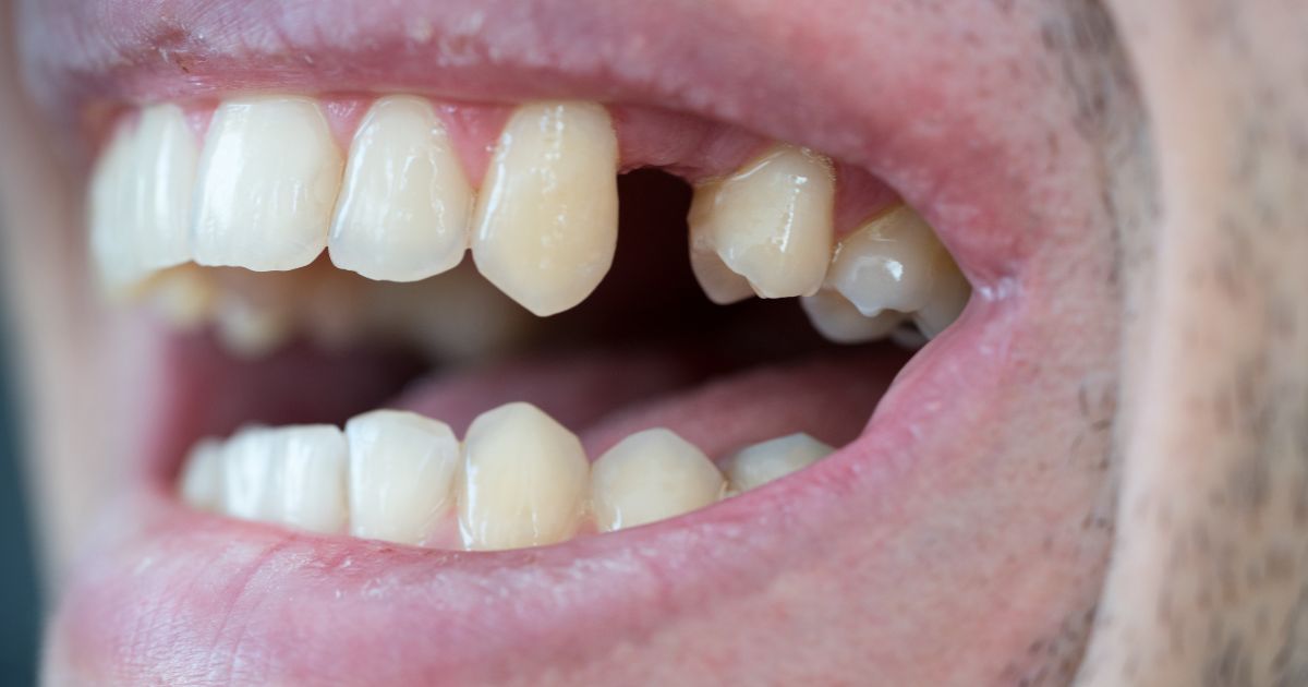 Agenesia - Clínica Dental Dentinos