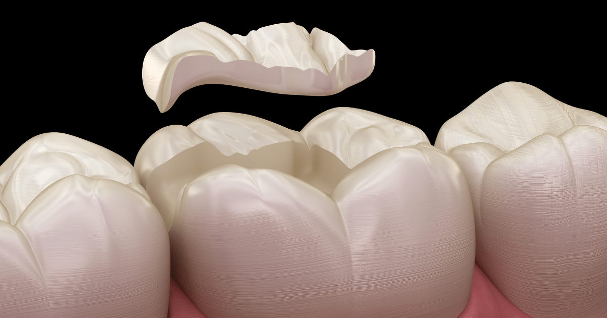 Incrustaciones dentales - Clínica Dental Dentinos Incrustaciones dentales
