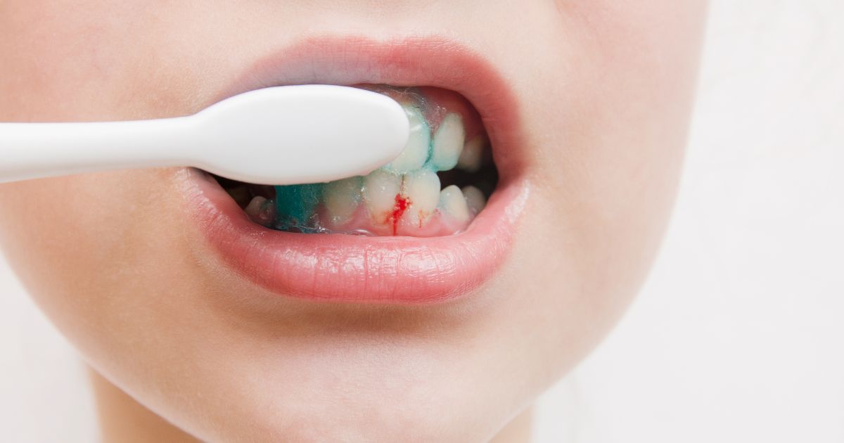 Gingivitis - Clínica Dental Dentinos