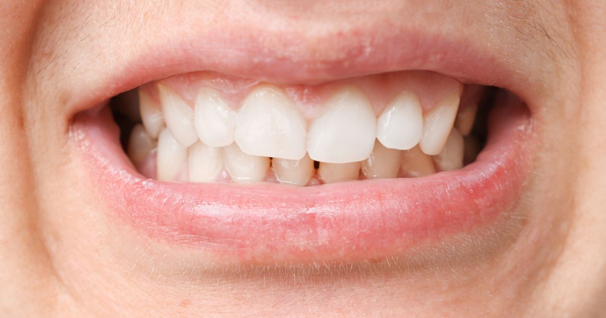 Mordida Cruzada - Clínica Dental Dentinos