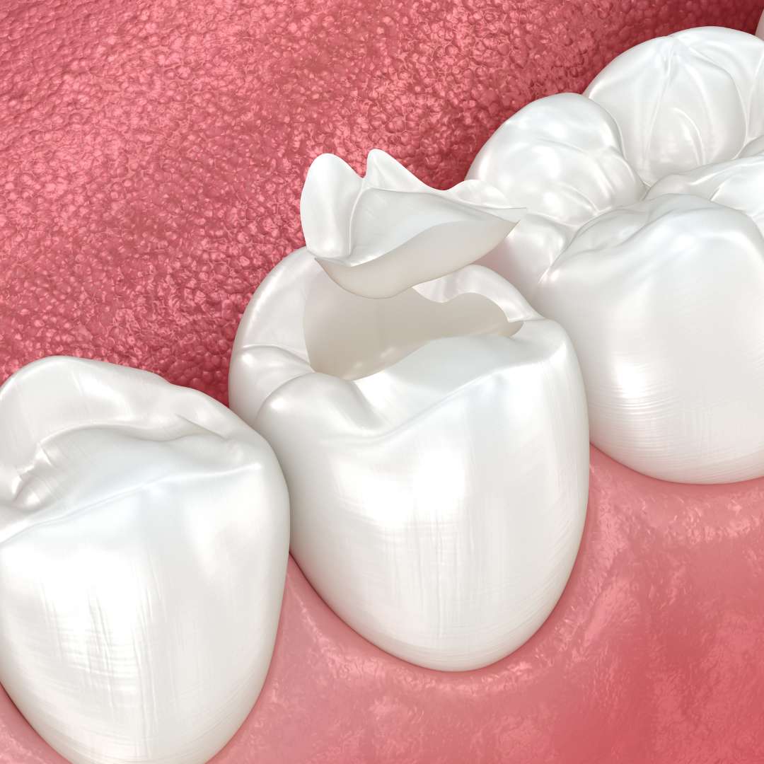 Incrustaciones dentales - Clínica Dental Dentinos Incrustaciones dentales - Clínica Dental Dentinos