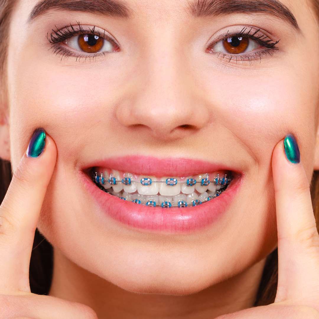 Brackets - Clínica Dental Dentinos brackets clinica dental dentinos