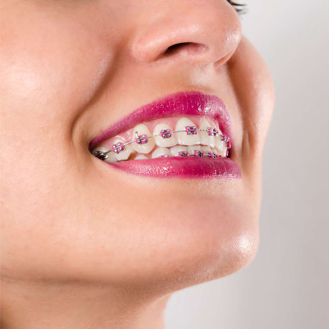 Brackets - Clínica Dental Dentinos brackets clinica dental dentinos