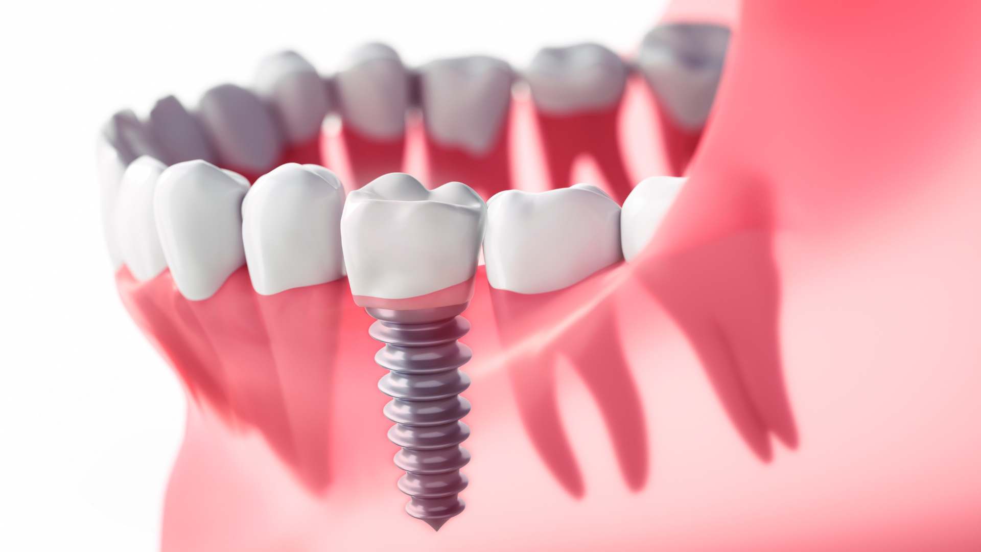 Implantes dentales - Clínica Dental Dentinos implantologia clinica dental dentinos