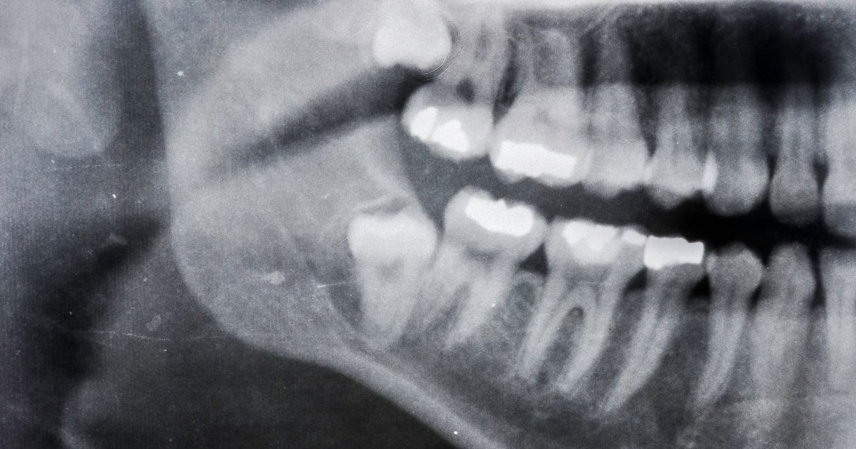 Dientes retenidos: Causas, síntomas y tratamientos