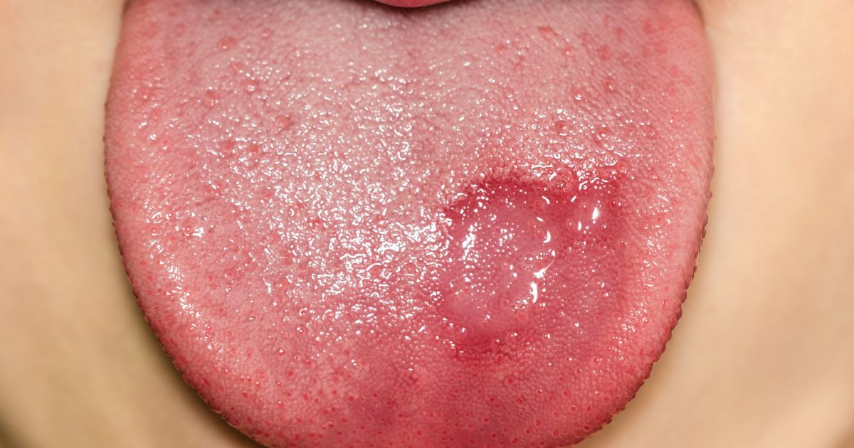 Hongos en la lengua