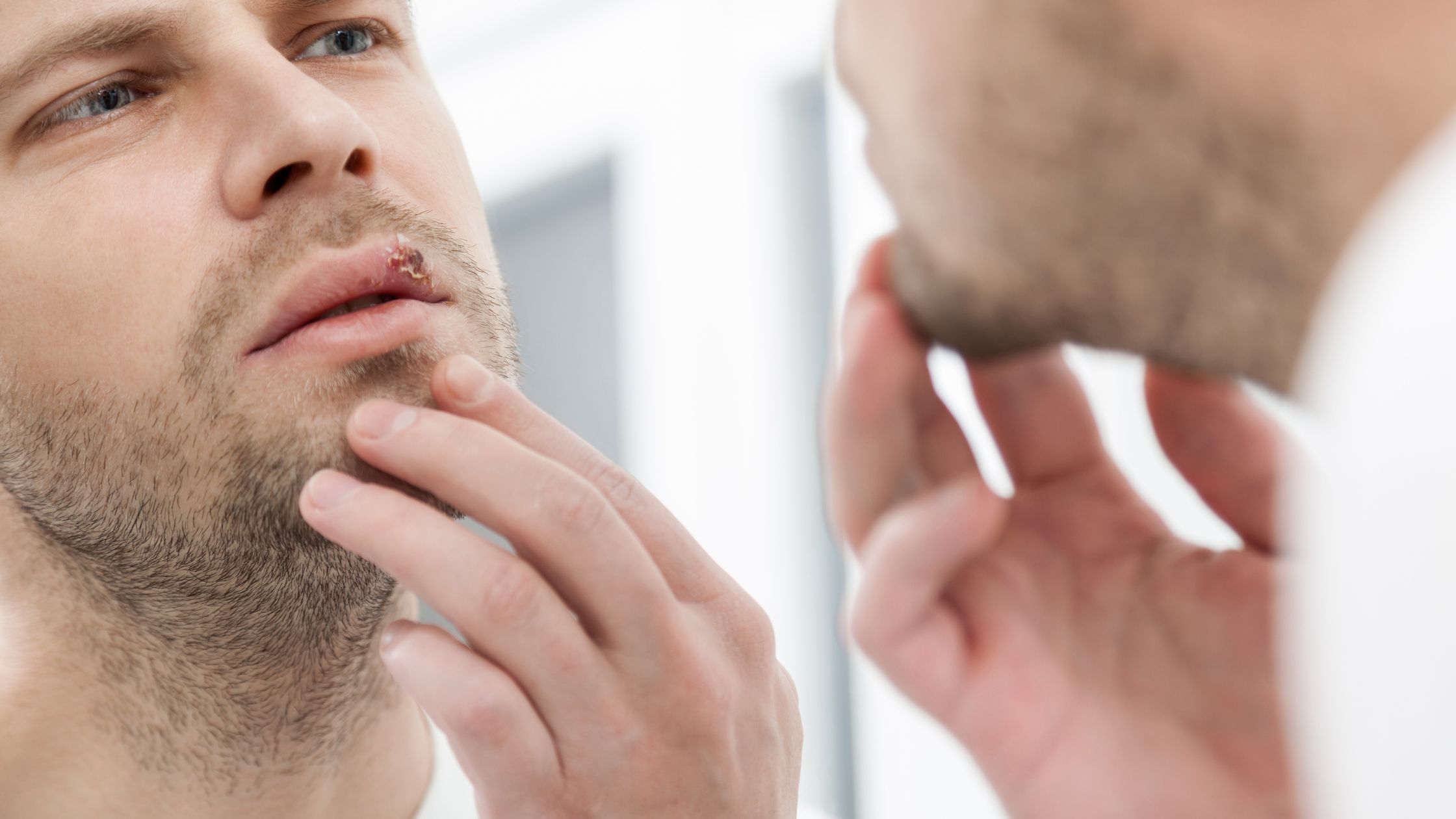 Calentura labial: causas y tratamiento