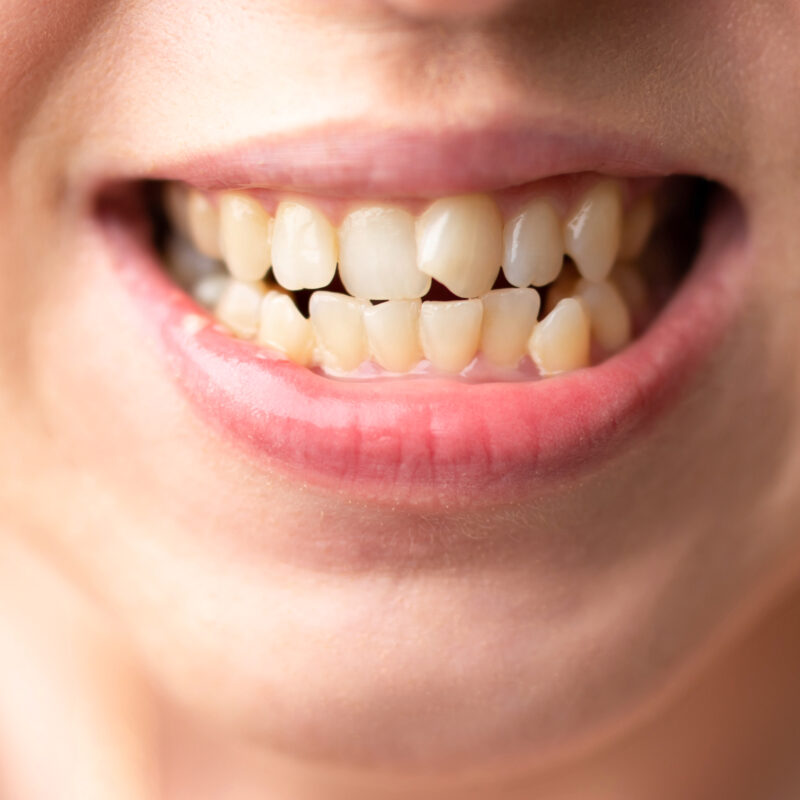 Apiñamiento dental en adultos: por qué se acentúa con los años - Clínica Dental Dentinos