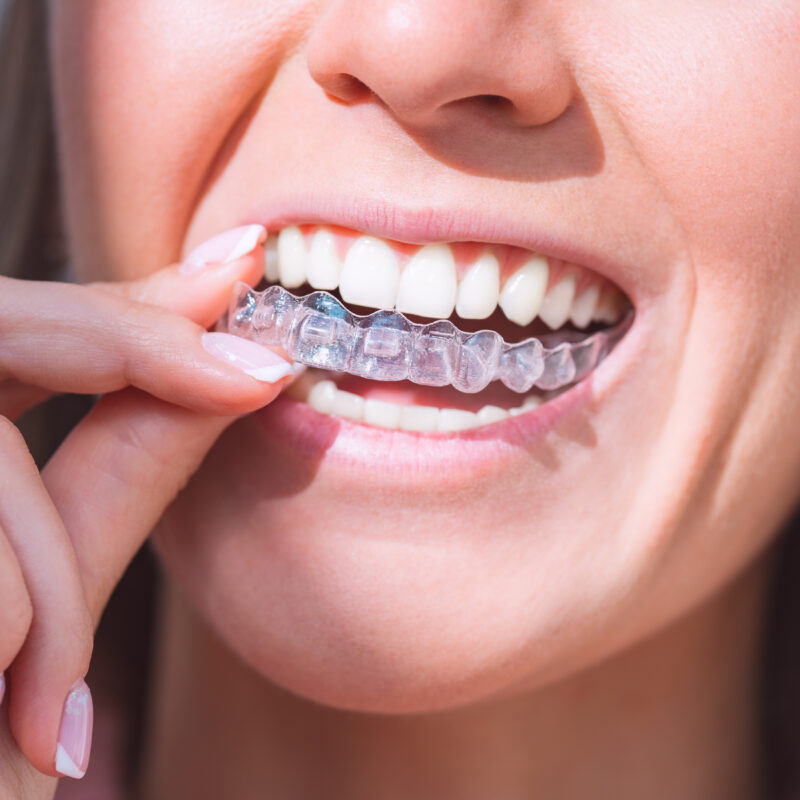 Invisalign casos complejos