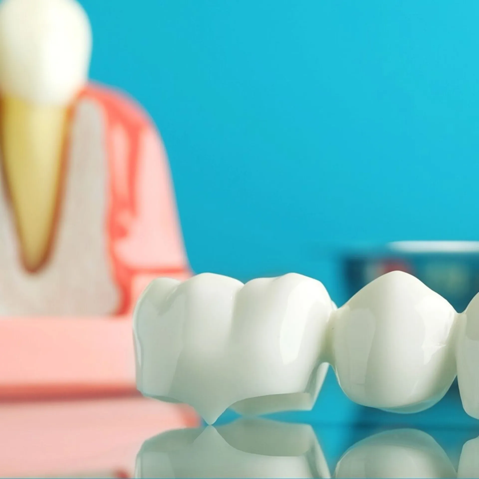Puente dental de cerámica en primer plano sobre una superficie reflectante en una clínica dental